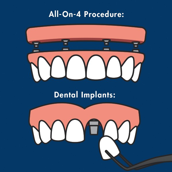 The All-On-4 Procedure Explained