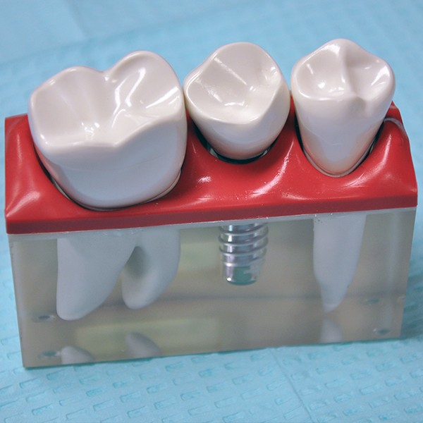 Caring For Dental Implants